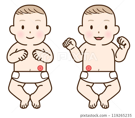 結腸造口、造口、大腸、兒童、兒童、嬰兒、插圖、插圖 119265235