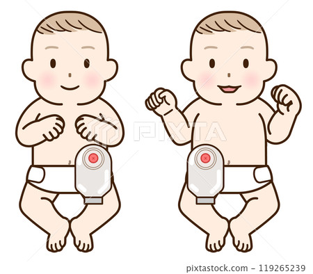 Artificial anus, stoma, colon, child, baby, illustration 119265239
