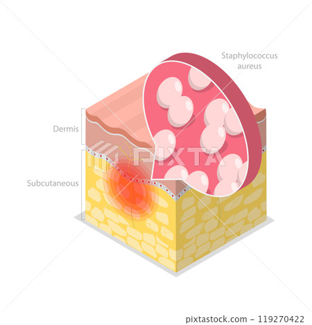 3D Isometric Flat  Illustration of Cellulitis, Bacterial Infection 119270422