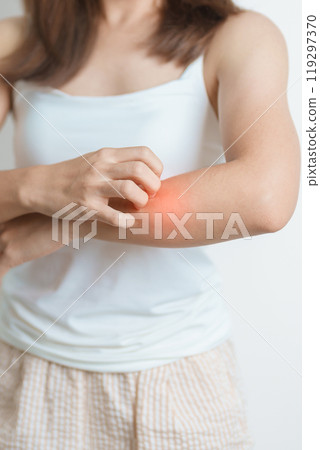 woman itching and scratching itchy arm. Sensitive Skin Allergic reaction to insect bite, food, drug dermatitis. Dermatology, Leprosy day, Systemic lupus erythematosus, Allergy symptoms and rash Eczema 119297370
