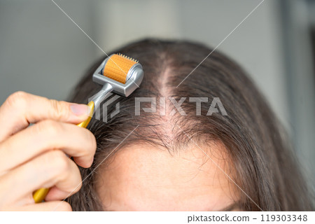Close up view of young woman using microneedle derma roller on head for stimulating new hair growth in home. Treatment for the healthy scalp. Close up view of young woman using microneedle derma roller on head for stimulating new hair growth in home. Treatment for the healthy scalp. 119303348