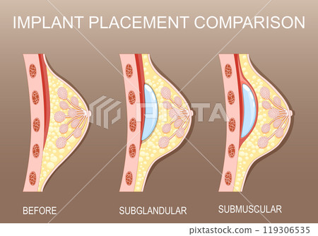 Breast implant placement. Cosmetic plastic surgery. Mammoplasty 119306535