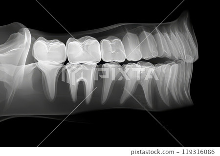 A dental x-ray image showing a wisdom tooth impaction 119316086