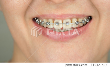 close-up smile. Braces, orthodontic construction on teeth. Dental health concept and bite correction. dental business 119321405