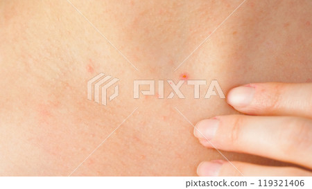 woman concerns irritated skin on the neck. skin with allergic reactions, acne. Care and treatment of problem skin. skin health. woman concerns irritated skin on the neck. skin with allergic reactions, acne. Care and treatment of problem skin. skin health. 119321406