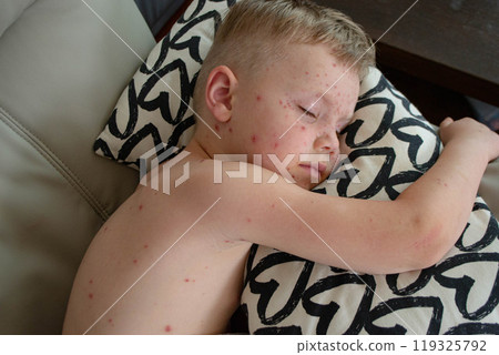 Natural vaccination. Contagious disease. 119325792
