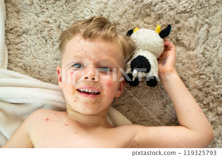 Natural vaccination. Contagious disease. 119325793