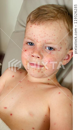 Natural vaccination. Contagious disease. 119326285