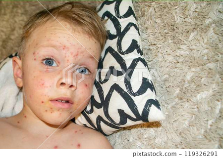 Natural vaccination. Contagious disease. 119326291