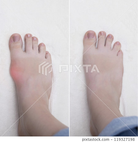 Hallux valgus, deformation of the big toe. Orthopedic doctor examines the bone on the foot, diagnoses foot pathology Hallux valgus, deformation of the big toe. Orthopedic doctor examines the bone on the foot, diagnoses foot pathology 119327198
