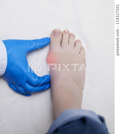 Hallux valgus, deformation of the big toe. Orthopedic doctor examines the bone on the foot, diagnoses foot pathology 119327201