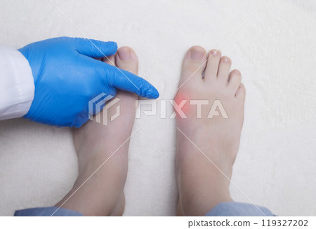 Hallux valgus, deformation of the big toe. Orthopedic doctor examines the bone on the foot, diagnoses foot pathology 119327202