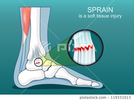 Ankle ligament sprain 119331013