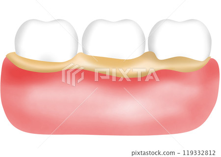 Teeth and gums with tartar Bacteria or plaque adheres 119332812