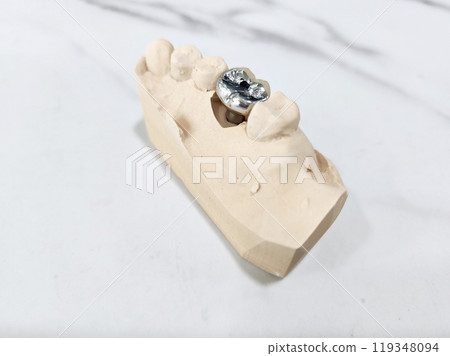 Dental Implant Crown 119348094