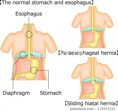 Esophagus stomach hernia illustration English Esophagus stomach hernia illustration English 119353232