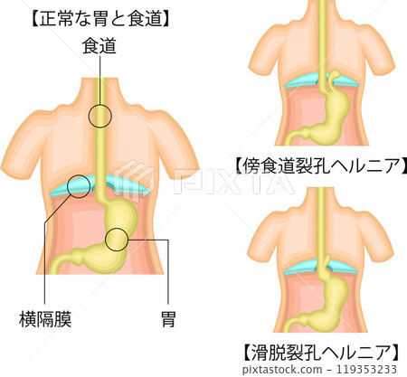 Esophagus stomach hernia illustration Japanese Esophagus stomach hernia illustration Japanese 119353233