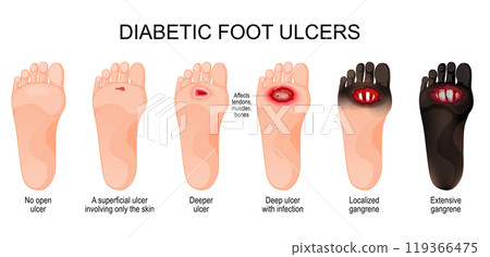 Diabetic foot ulcers. Classification Diabetic foot ulcers. Classification 119366475