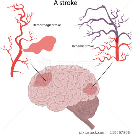 . Hemorrhagic stroke and ischemic stroke of the brain. . Hemorrhagic stroke and ischemic stroke of the brain. 119367806