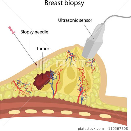 Diagnosis of breast disease Diagnosis of breast disease 119367808