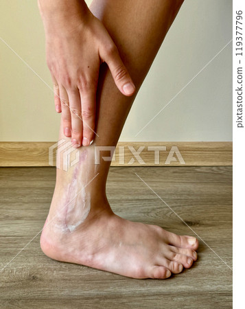 Concept treatment by applying cream by hand to after surgery scar on the ankle 119377796