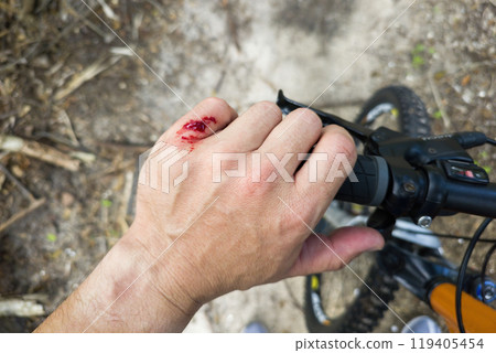 Mountain bike accident. Rider hand wound with red blood from hitting a tree stump Mountain bike accident. Rider hand wound with red blood from hitting a tree stump 119405454