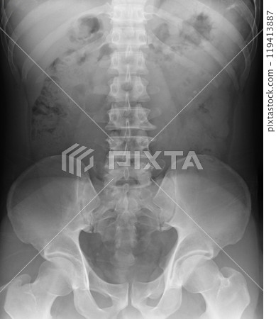 spine,pelvis,hip joint x-ray spine,pelvis,hip joint x-ray 119413887