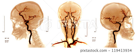 blood vessels image in the brain blood vessels image in the brain 119413934