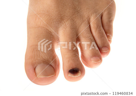 Internal bleeding in a man's toenail Internal bleeding in a man's toenail 119460834