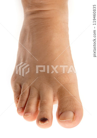 Internal bleeding in a man's toenail Internal bleeding in a man's toenail 119460835