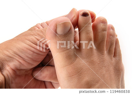 Internal bleeding in a man's toenail 119460838