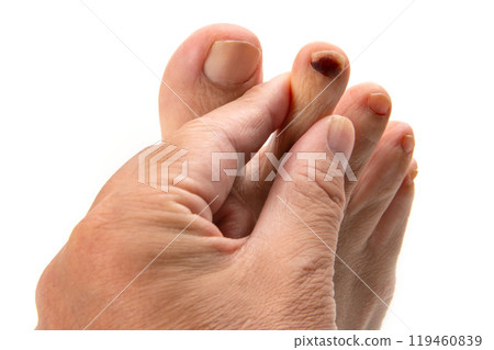 Internal bleeding in a man's toenail 119460839
