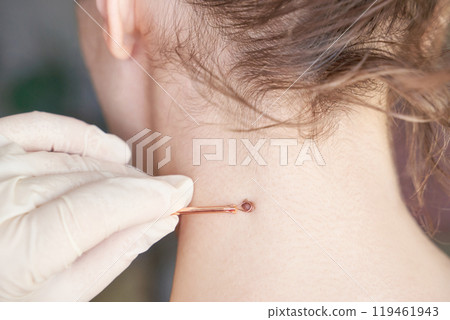 Woman examing her abnormal mole. Dermatology procedure. Doctor checking 119461943