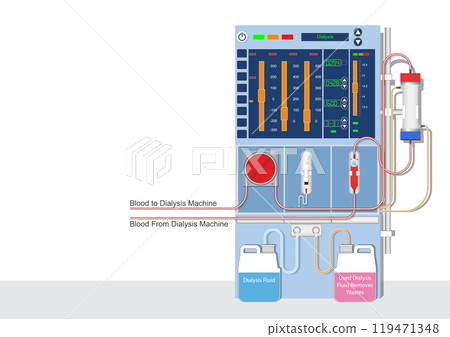Hemodialysis is a machine filters wastes. 119471348