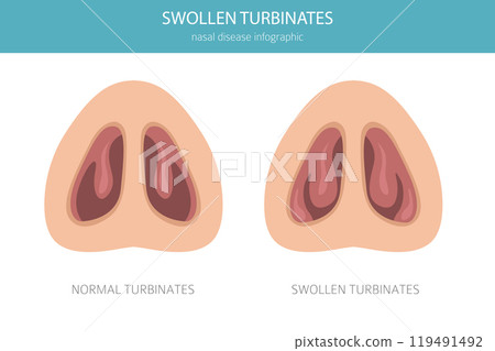 Swollen turbinates. Nasal diseases. Medical infographic design Swollen turbinates. Nasal diseases. Medical infographic design 119491492