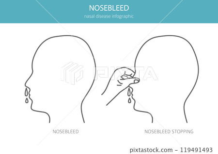 Nosebleed. Nasal diseases. Medical infographic design 119491493