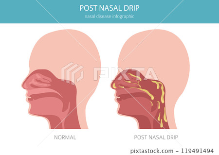 Post nasal drip. Nasal diseases. Medical infographic design 119491494