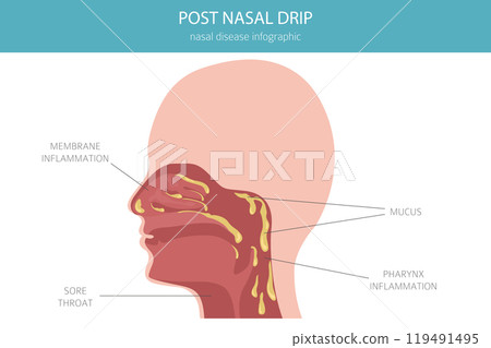 Post nasal drip. Nasal diseases. Medical infographic design Post nasal drip. Nasal diseases. Medical infographic design 119491495