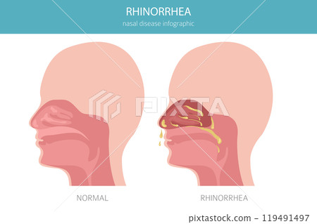 Rhinorrhea, rhinitis. Nasal diseases. Medical infographic design Rhinorrhea, rhinitis. Nasal diseases. Medical infographic design 119491497