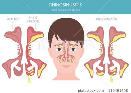 Rhinosinusitis. Nasal diseases. Sinusitis, sinus infection diagnosis and treatment medical infographic design Rhinosinusitis. Nasal diseases. Sinusitis, sinus infection diagnosis and treatment medical infographic design 119491498