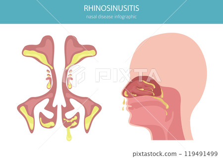 Rhinosinusitis. Nasal diseases. Sinusitis, sinus infection diagnosis and treatment medical infographic design 119491499