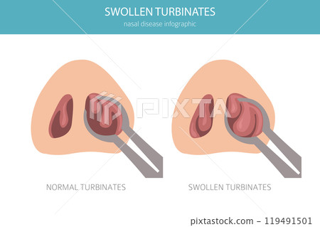 Swollen turbinates. Nasal diseases. Medical infographic design Swollen turbinates. Nasal diseases. Medical infographic design 119491501