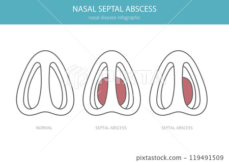 Nasal septal abscess. Nasal diseases. Medical infographic design Nasal septal abscess. Nasal diseases. Medical infographic design 119491509