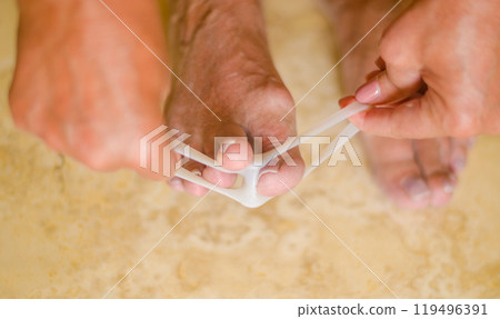 Treatment of hallux valgus. Woman applies valgus splint, silicone finger spacer. High quality photo 119496391
