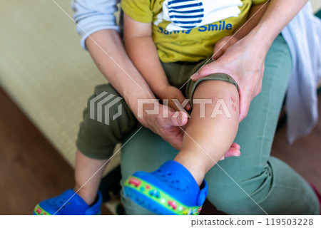 被昆蟲叮咬的 2 歲男孩微笑著 119503228