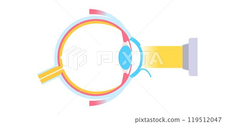 Lasik eye surgery Lasik eye surgery 119512047