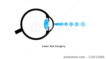 Lasik eye surgery 119512066