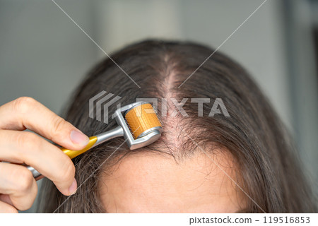 Close up view of young woman using microneedle derma roller on head for stimulating new hair growth in home. Treatment for the healthy scalp. 119516853