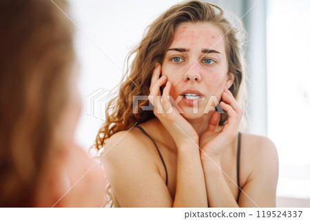 Young woman looks in mirror examining inflammation on her face. Acne skin. Medicine and cosmetology. 119524337