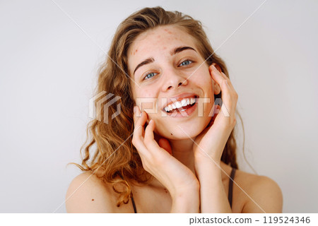Portrait of beautiful young woman with inflammations on skin of her face. Medicine and cosmetology. 119524346
